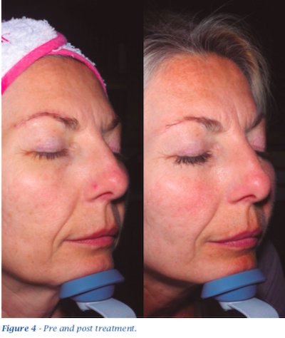 pre and post treatment bio restructuring