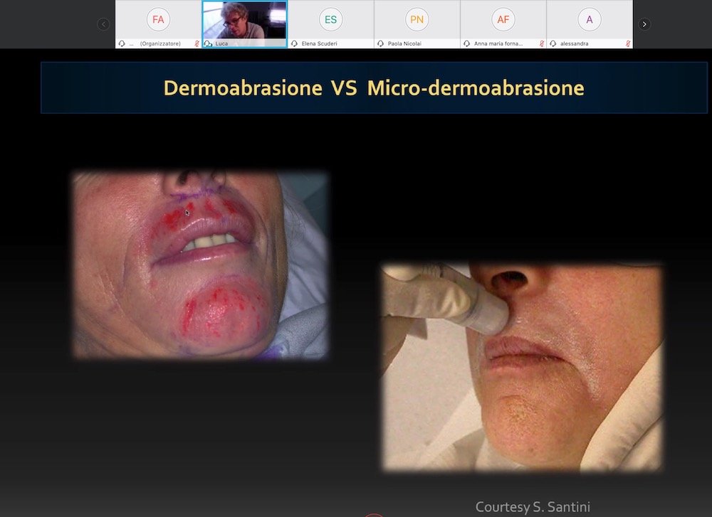 dermoabrasione vs micro dermoabrasione