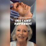 mantenimento dopo il lifting del viso